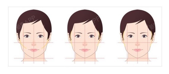 面部美学标准有多种评价方法,其中之一就是三庭五眼,即纵向可分为5