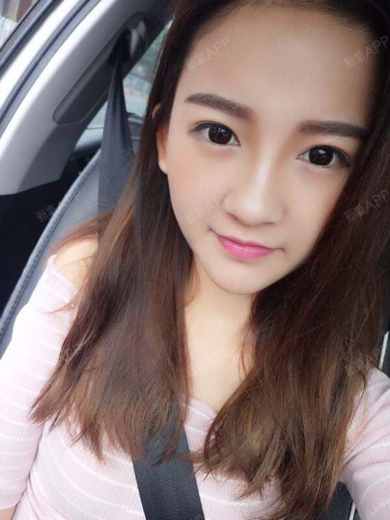 埋线法(亦有称之为高分子成型法),是通过缝合方