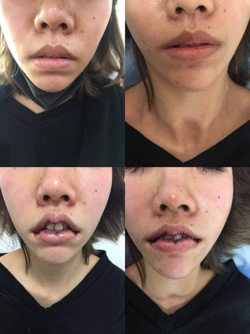 第一天厚唇改薄坐了几个小车动车才到打麻药真的很痛