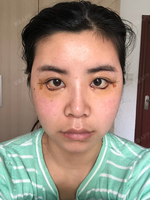 开外眼角 | 术后当自强 | 上海同城 | 石家庄同城 | 下眼下至术