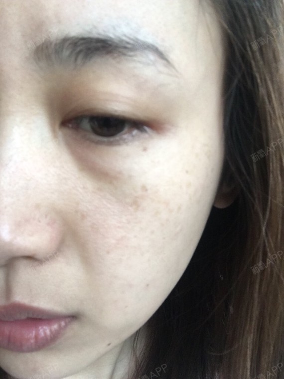 激光祛斑镭射净肤皮秒激光有什么区别呀雀斑最