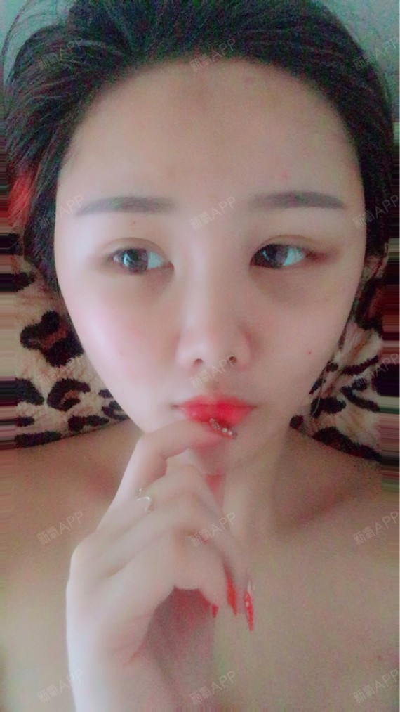 刚做完脂肪填充第三天,眼睛肿起来了,会不会是脂肪散开到眼睛