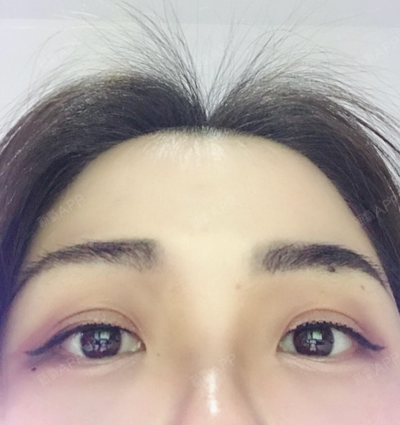 种植眉毛