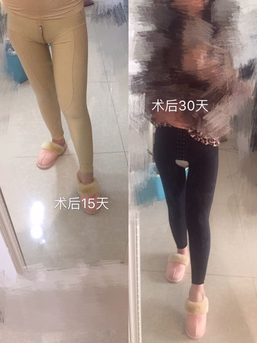 吸脂瘦大腿第30天