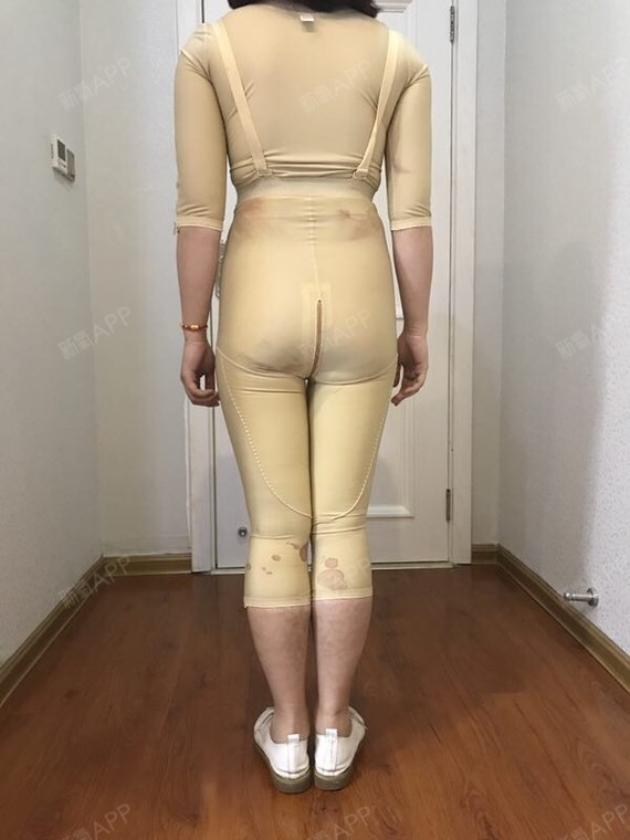 吸脂