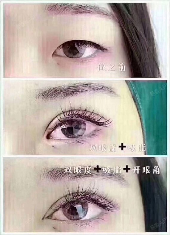 【武汉叶子整形美容医院-竺湘云】眼睛综合12