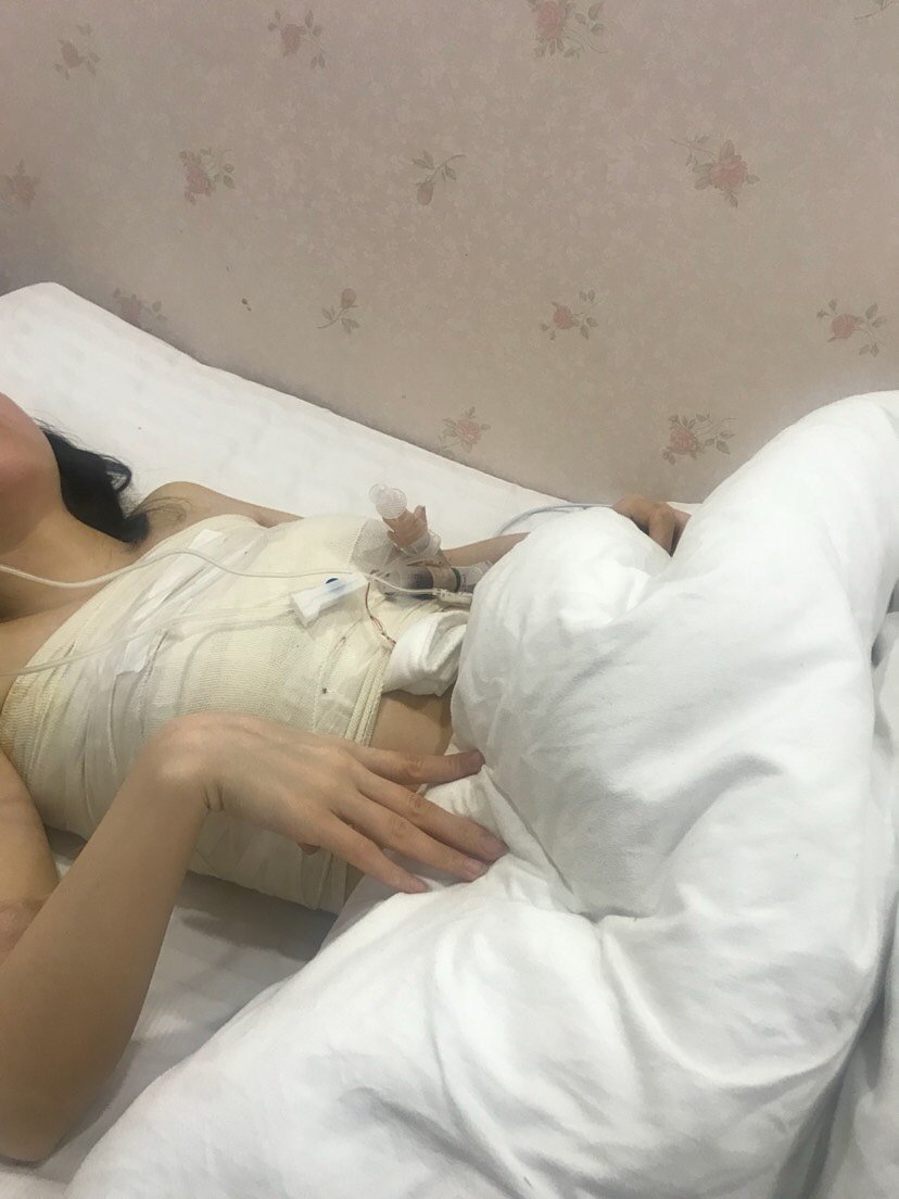 假体隆胸第0天