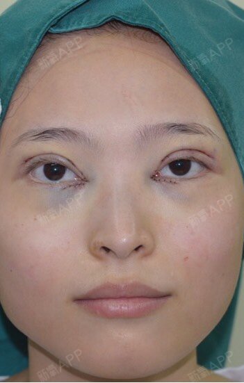 执念念念切开双眼皮第0天美丽日记-新氧美容整形