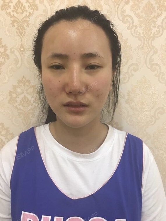 【上海奉浦&内眼角】防止内眼角处瘢痕增第二v眼角小学邹城市图片