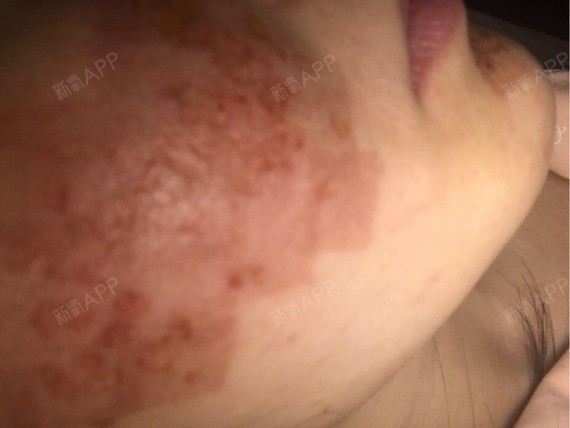 朵鱼点阵激光第2天美丽日记-新氧美容整形