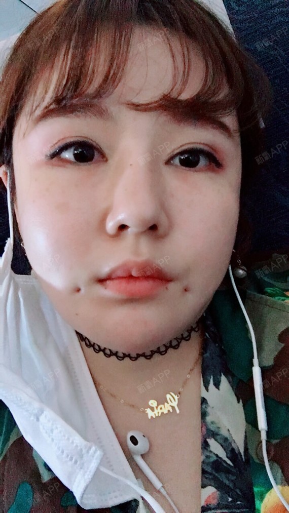 现在做酒窝的人越来越多了,我也是个爱跟风的人,怎么说呢,小手术的话