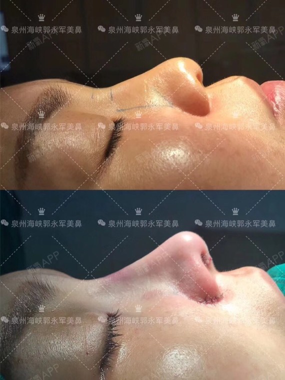 鼻尖下坠,鼻基底凹陷,宽鼻,今日行骨粉取出,自体肋软骨膨体综合隆鼻
