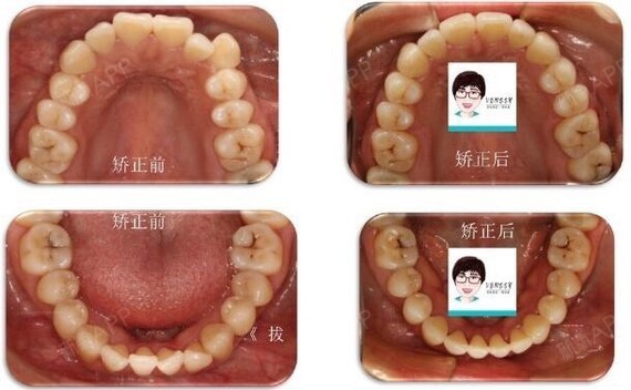 这位患者不仅上下牙终于可以正常咬合了,也拥有了一口健康完美的牙齿!