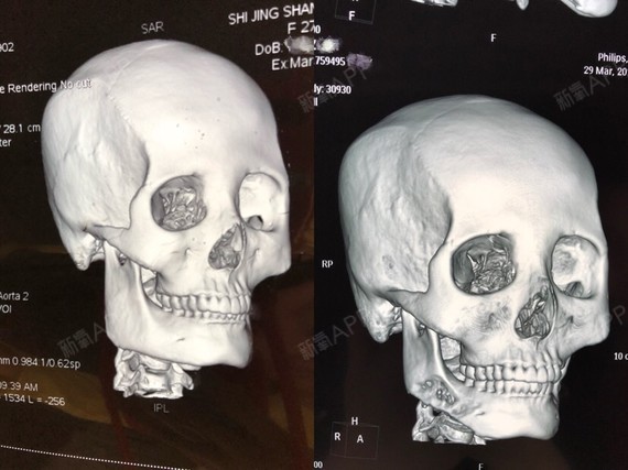 3.26做的下颌角手术通过ct图片看,能_圈子-新氧美容整形