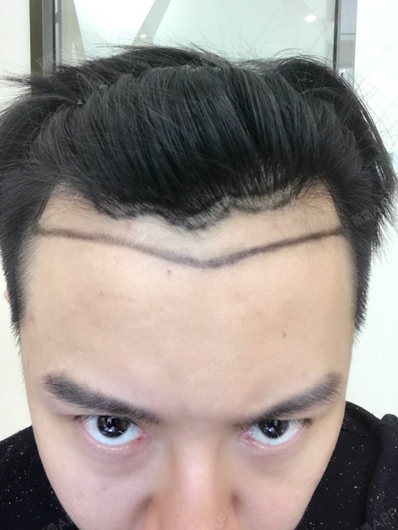 动力大板砖种植发际线第0天美丽日记-新氧美容