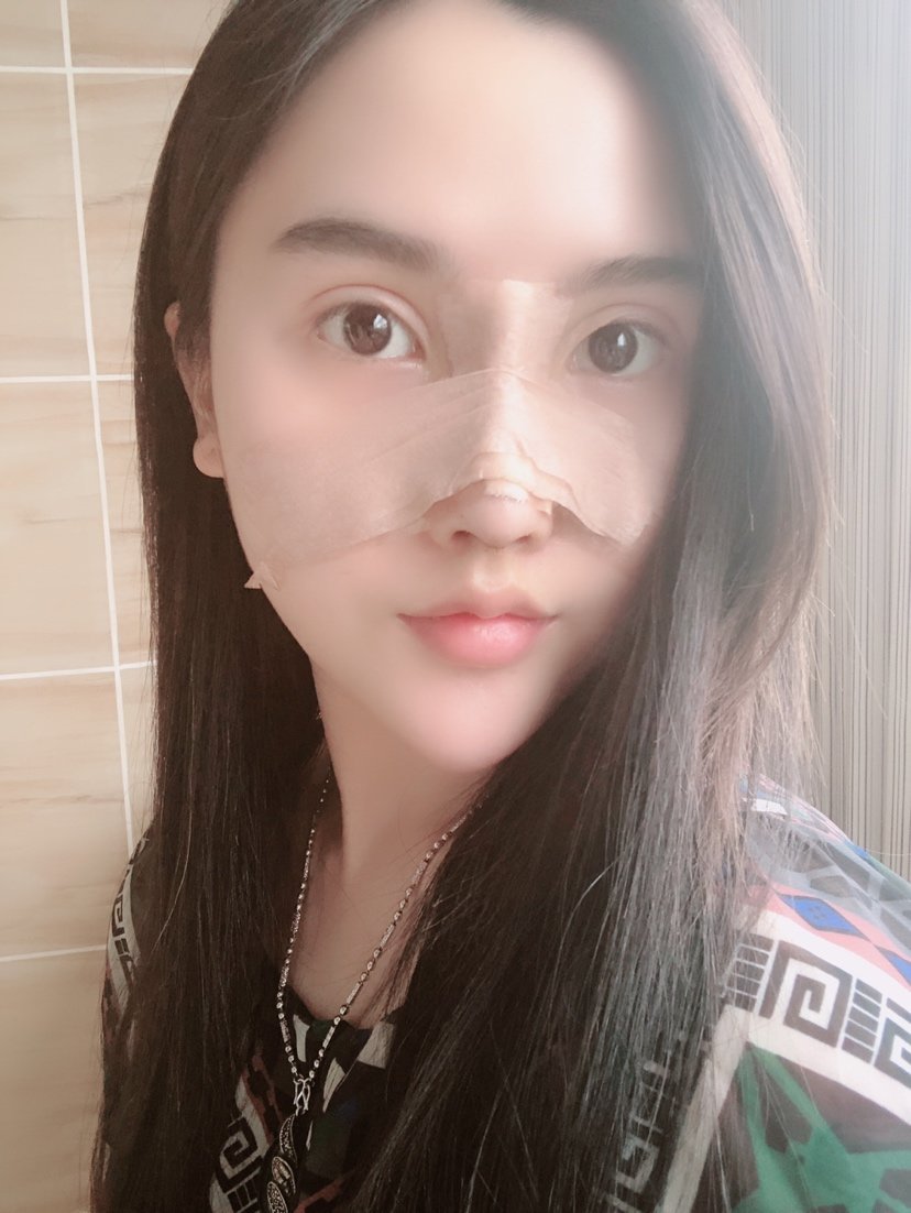 肋骨隆鼻