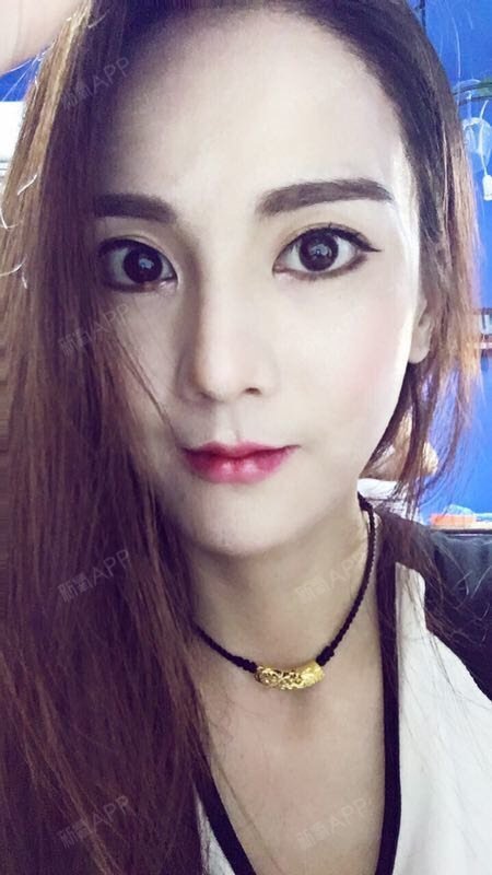 手术方案:上唇m唇 唇珠成形 下唇嘟嘟唇,上唇做m唇改善唇峰