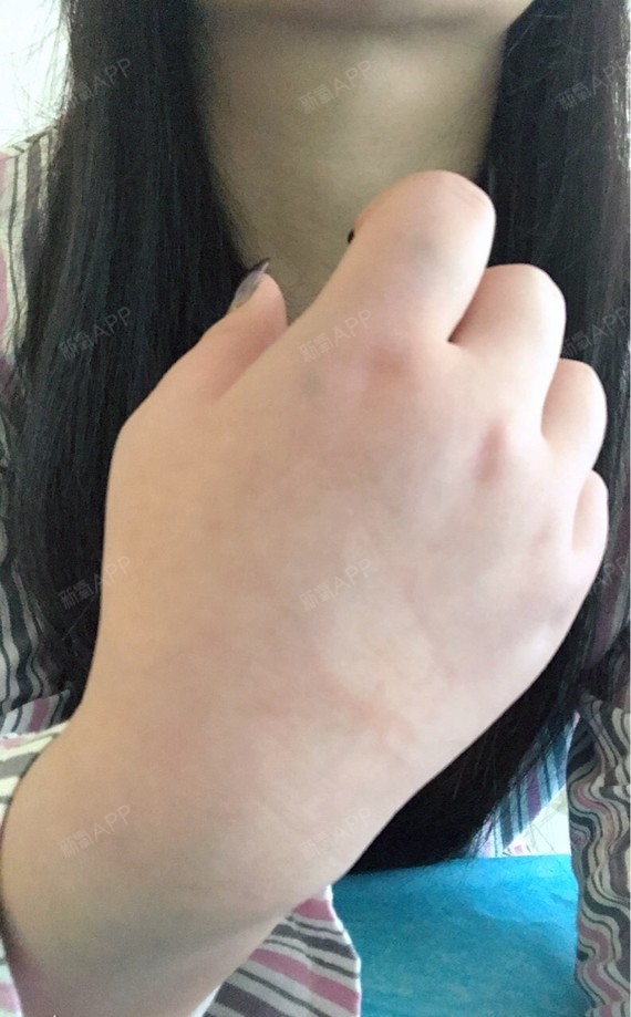 护士上班就开始给我输液了  因为第二天是最肿的,手太肿找不到血管