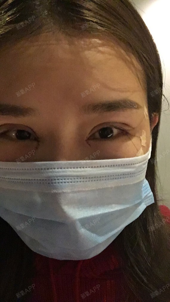 做完上双眼皮第十天了现在两只眼睛有点不一样