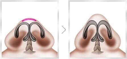 安黛美整形]鼻头缩小术就是缩小鼻子的大小、