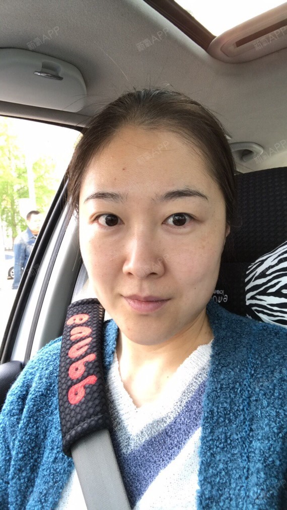 时光机器呀埋线提升第57天美丽日记-新氧美容