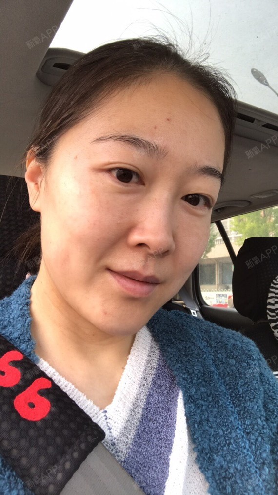 时光机器呀埋线提升第57天美丽日记-新氧美容