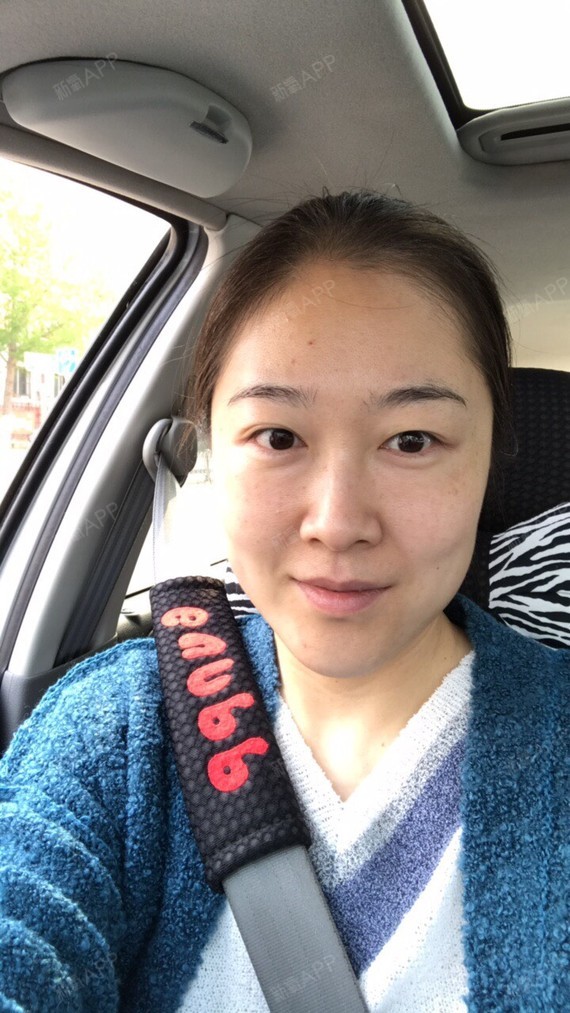 时光机器呀埋线提升第57天美丽日记-新氧美容