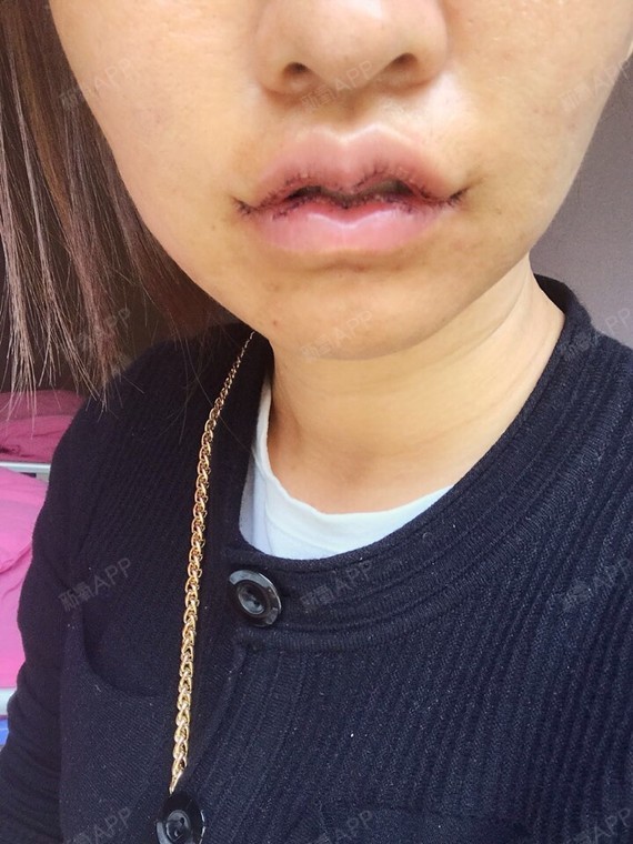 m唇手术