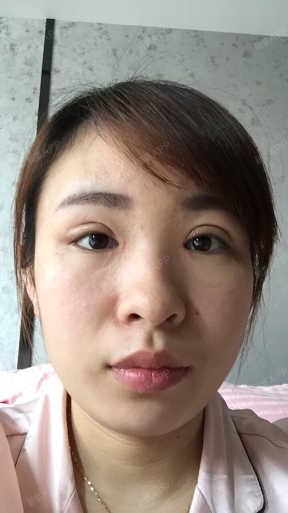 男生们是非开内眼角第23天美丽日记-新氧美容