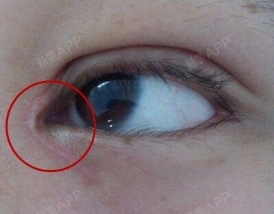 预防眼部炎症发生,因为这种情况有可能造成新生的伤口部位发生粘连