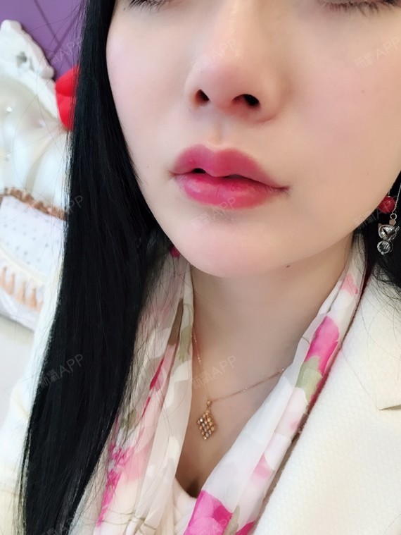 m唇手术