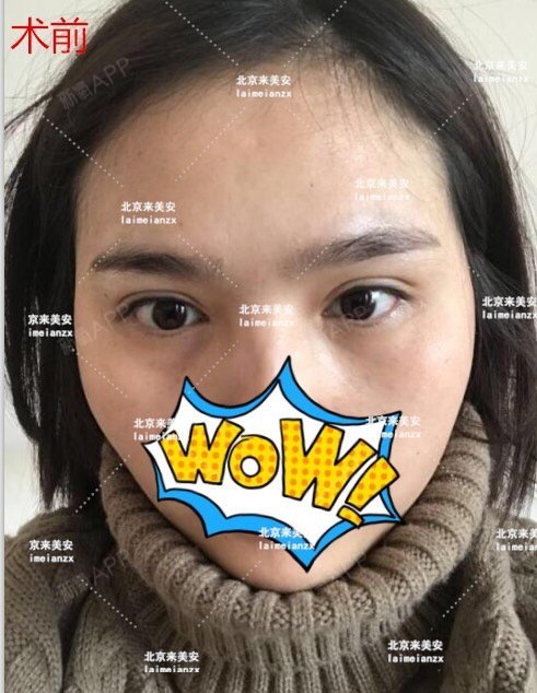 小美女内眼角失败后通过网络方式到处寻找修复