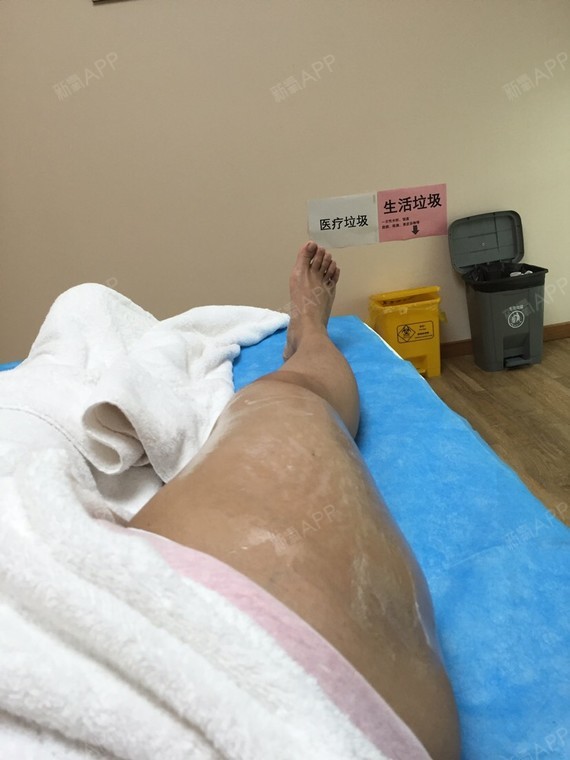 新氧- 李祎 | 美体塑形 | 激光溶脂瘦大腿 | 术后当自强 | 广州同城