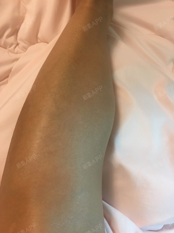 肌肉型小腿 打肉毒素针的效果比较好还是吸脂效果比较好