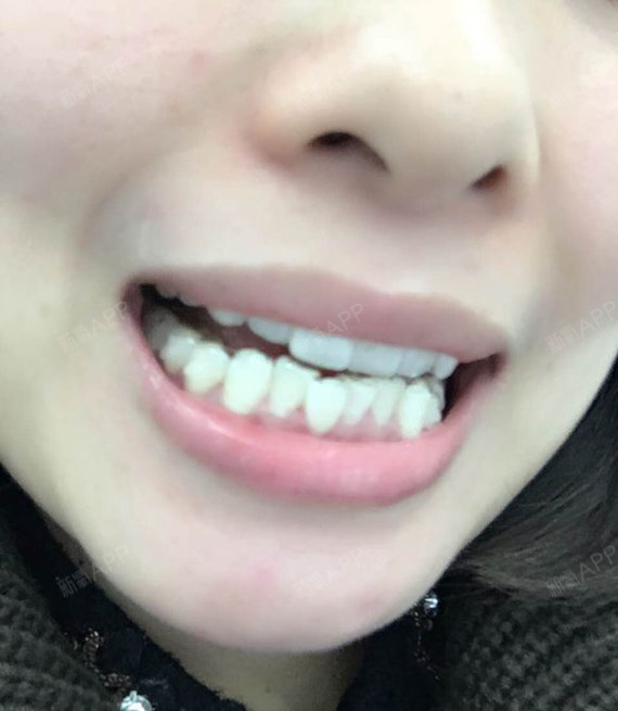 27岁,牙齿问题:有点突嘴,下巴后缩,右侧咬合过度,下牙弓形方