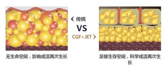自体脂肪移植隆胸是将人体自身某些部位多余的皮下脂肪细胞,经过吸出