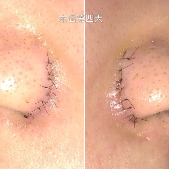 开始有点担心疤痕跟增生的问题,今天稍微消肿了一点点,但鼻翼还是比较