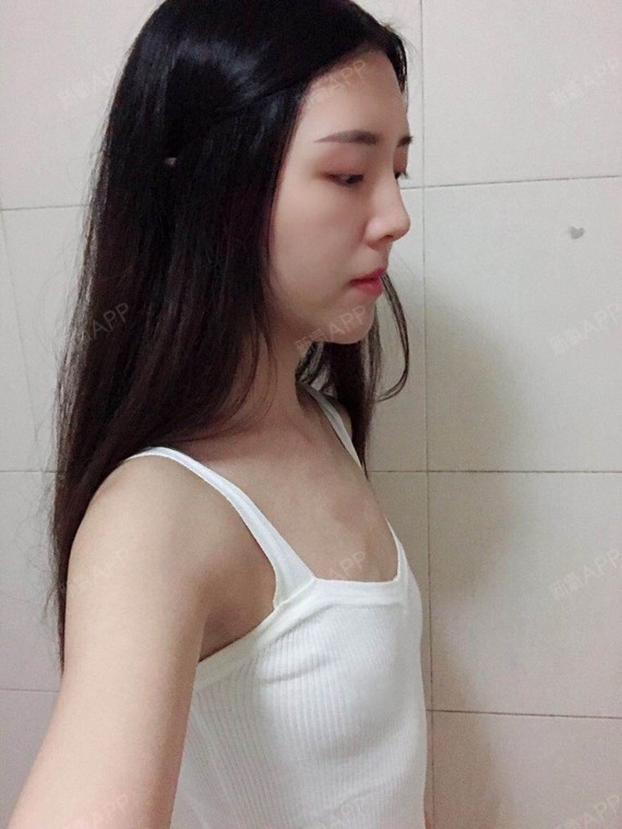 厦门美莱3d内窥镜魅惑深v酥胸#最后还是决定来做手术了,是男朋友陪我
