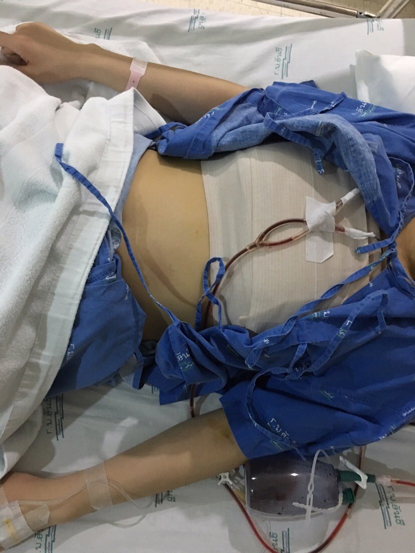 泰国yanhee国际医院假体隆胸怎么样?_澳车厘子美丽