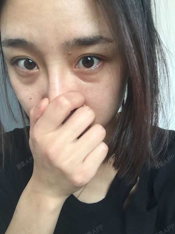 报名水谷和则院长手术去除黑眼圈,眼袋