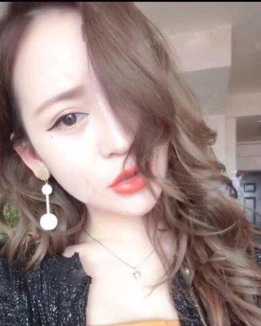 氧气7359061525770992玻尿酸丰泪沟第7天美