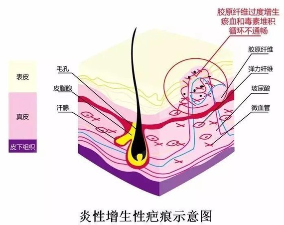 真皮及皮下组织严重损伤,成纤维细胞聚集增生,胶原纤维,细胞,基质沉积