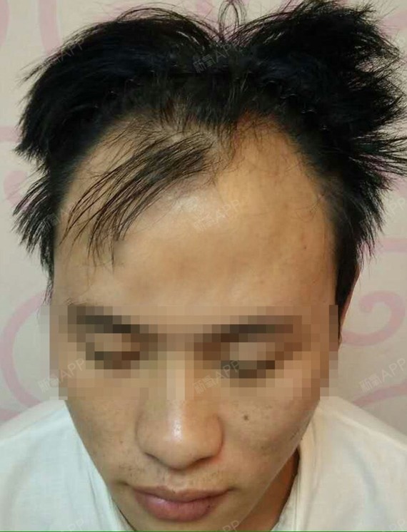 郑州欧兰植发姚护士Ln980009头顶加密种植第