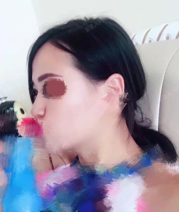 已经十天了一点变化也没有。鼻根这个鼓包我摸