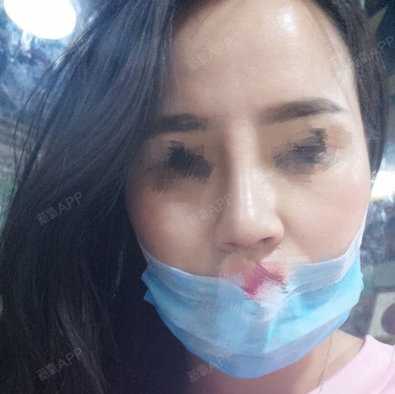 已经十天了一点变化也没有。鼻根这个鼓包我摸