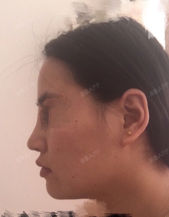 已经十天了一点变化也没有。鼻根这个鼓包我摸