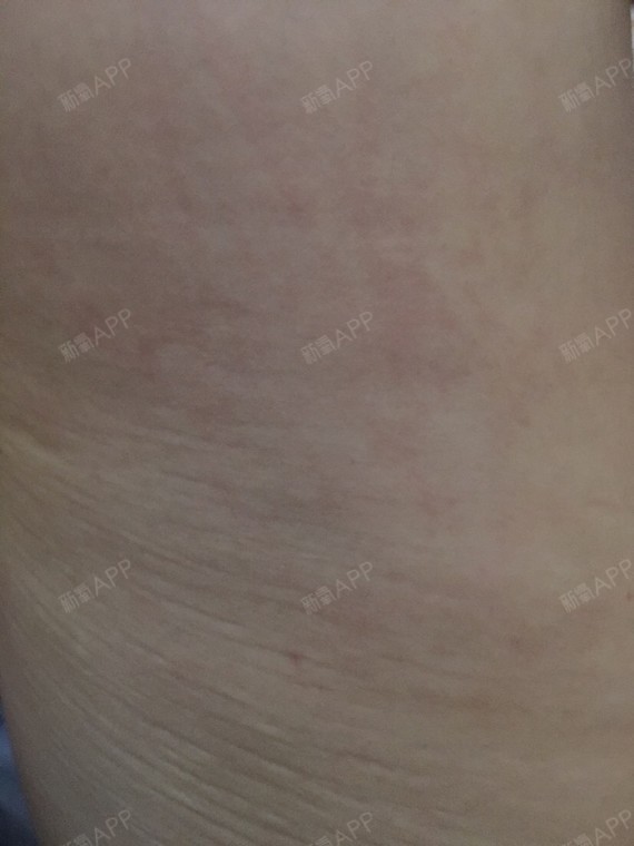 氧气9579341519455528吸脂瘦大腿第74天美