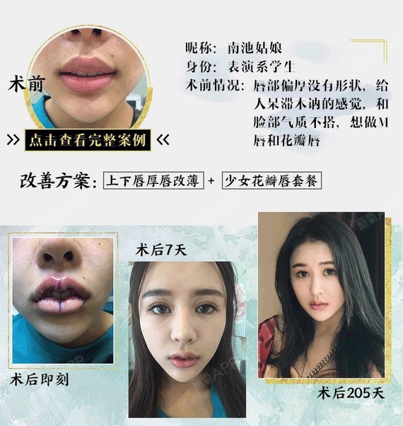 m唇手术