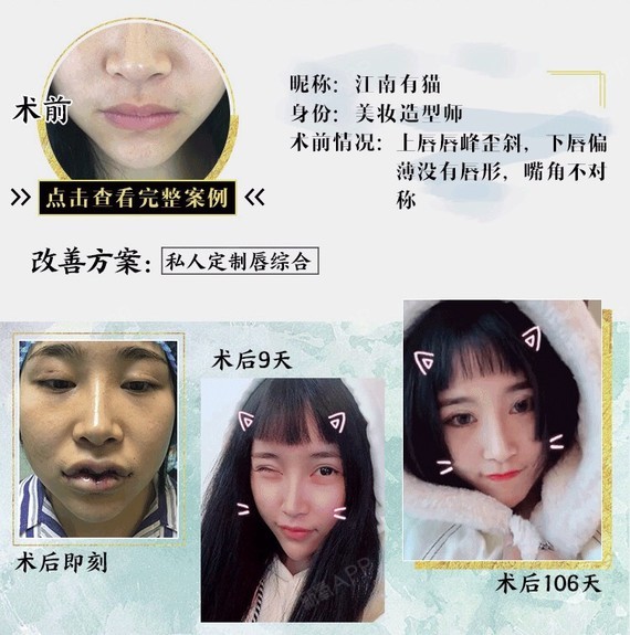 m唇手术