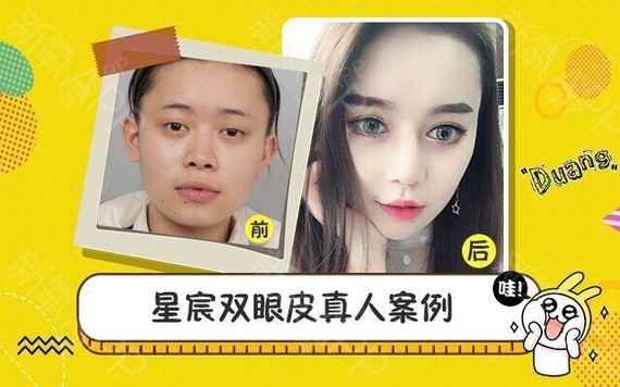 双眼皮术后注意事项1、48-72小时内间断冰敷